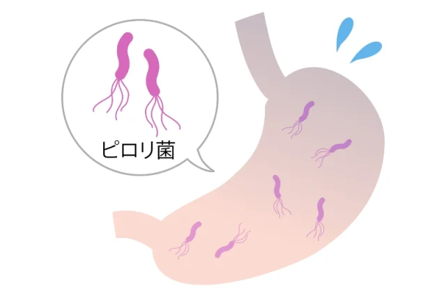 【意外と知らない】ピロリ菌と胃の病気1